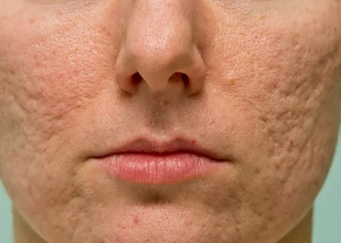 acne aberdeen treatments